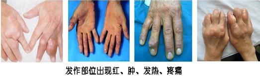 貴陽強(qiáng)直醫(yī)院手部痛風(fēng)癥狀.jpg