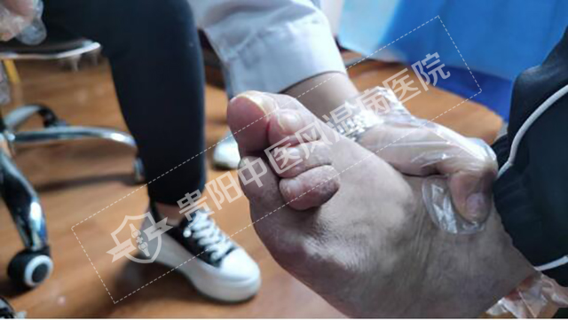 類風(fēng)濕導(dǎo)致的指關(guān)節(jié)畸形殘疾2.jpg