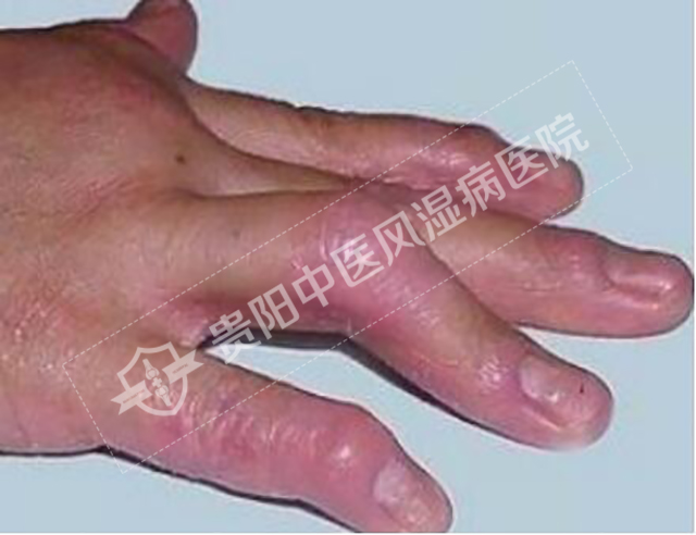 骨關(guān)節(jié)炎導(dǎo)致的關(guān)節(jié)腫脹1.jpg