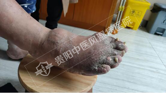 痛風(fēng)性關(guān)節(jié)炎導(dǎo)致無法正常穿鞋2.jpg