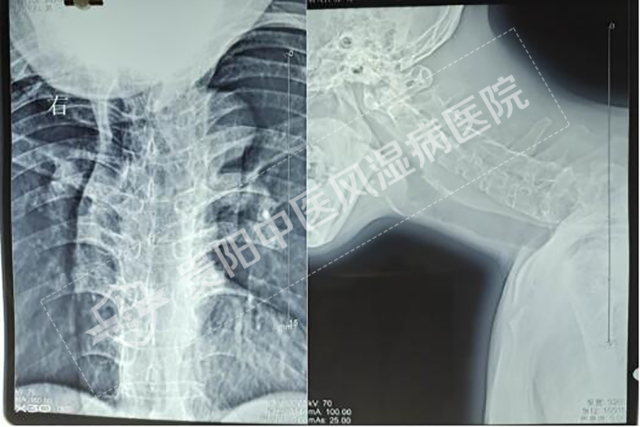 強直性脊柱炎患者影像2.jpg