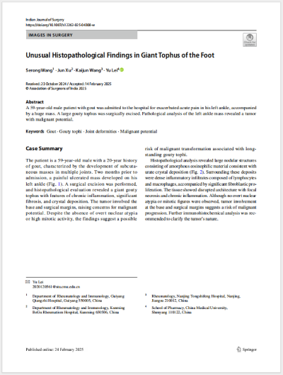 25ɫεȹͬ׫(xi)¡Unusual Histopathological Findings in Giant Tophus of the Foot㲿޴ʹL(fng)ʯĮMW(xu)F(xin)SCIڿIndian Journal of Surgeryl(f).png